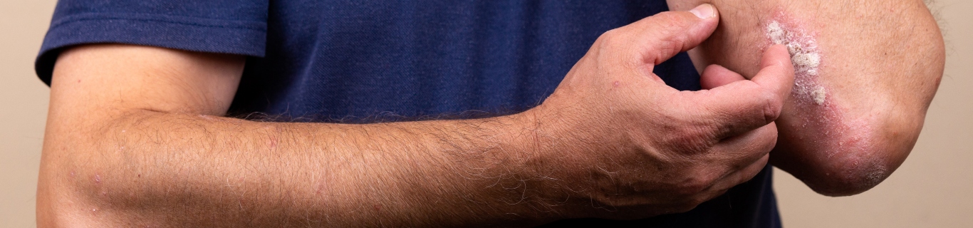Pourquoi utiliser le liniment contre l’eczéma ?