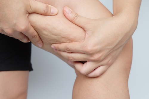 cellulite sur une cuisse